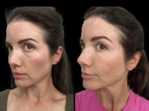 How Lifestyle Affects Results of Dark Circles Treatment in Dubai