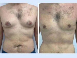 Understanding How Body Type Influences Results With the Best Gynecomastia Surgeon in Dubai