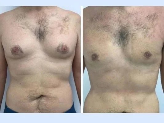 Understanding How Body Type Influences Results With the Best Gynecomastia Surgeon in Dubai