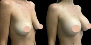 What Makes the Best breast Enhancement surgeons in dubai Industry Leaders