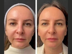 How Safe Is Mesotherapy Treatment in Dubai? Expert Insights and Precautions