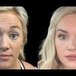 The Rise of Preventative Botox Among Millennials at the Best Aesthetic Clinics in Dubai