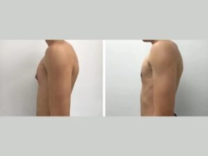 The Best Gynecomastia Surgeon in dubai for Life-Changing Results