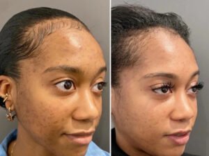 How Chemical Peel Treatment in Dubai Is Revolutionizing Skincare for All Ages