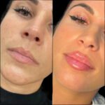 Fillers Treatments in Dubai: Achieving Youthful Skin Naturally