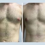 Gynecomastia in Dubai: What Makes Dubai a Medical Tourism Hub