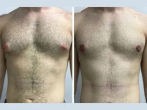Gynecomastia in Dubai: What Makes Dubai a Medical Tourism Hub