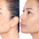 Latest Skin Whitening Technology in Islamabad