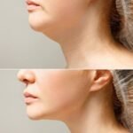 Jaw Surgery in Islamabad – Improve Functionality and Facial Symmetry