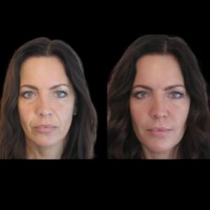 Everything About Jawline Fillers Treatments in Dubai for Men and Women