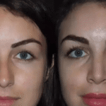 The Role of the Best Rhinoplasty Surgeon in Dubai in Facial Harmony