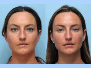 Sculpted Perfection Awaits at the Best Aesthetic Clinics in Dubai for Thread Lift