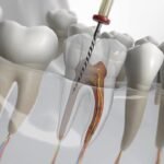 Restore Your Smile with Expert Root Canal Treatment In Islamabad