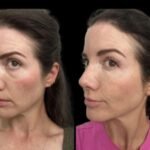 Top Rated Clinic with the Best Doctors in Dubai for Dark Circles Treatment