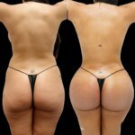 Everything You Should Know About the Safety of Butt Fat Transfer in Dubai