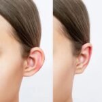 Cosmetic Ear Surgery in Islamabad