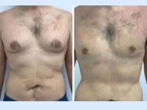 Combining Liposuction and Tissue Removal Techniques by the Best Gynecomastia Surgeon in Dubai