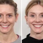 Best Doctors in Dubai Outline 2025 Thread Lift Trends