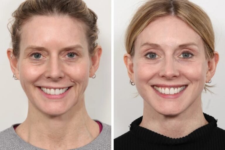 The Future of Cosmetic Enhancements with Thread Lift in Dubai