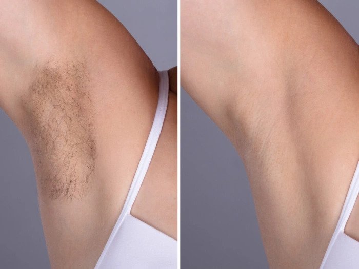 Best Doctors in dubai for Laser Hair Removal: Your Guide to Permanent Results