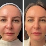 How Long Do Results Last from Mesotherapy in Dubai?