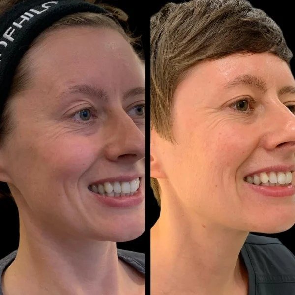 Capture a Natural Beauty Glow with Profhilo from Best Doctors in dubai