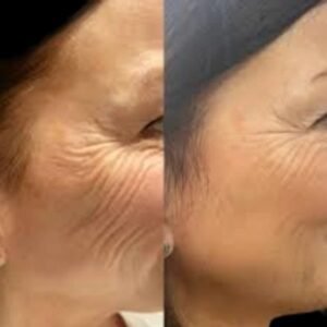 Illuminates Natural Glow the Profhilo from Best Doctors in dubai