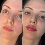 Best Doctors in dubai for Precision-Based Fillers Injections