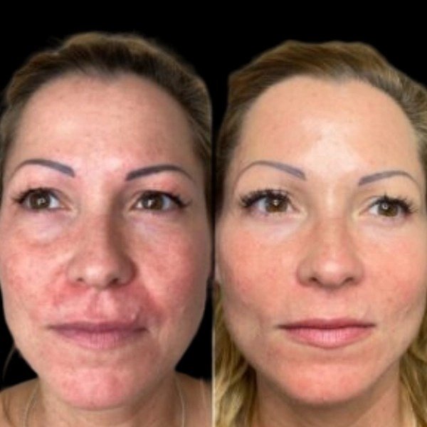 Experiences Renewal using with Profhilo Treatment in Dubai