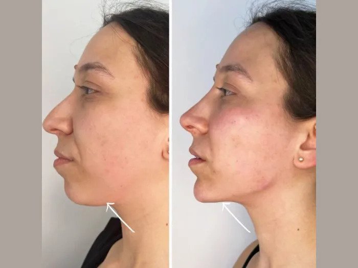 Reveal a More Youthful You with Advanced Endolift in Dubai