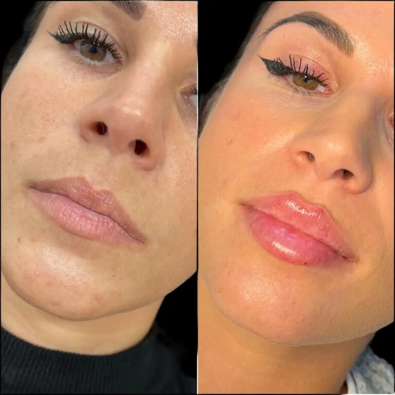 Fillers Treatments in Dubai: Where Art Meets Aesthetics