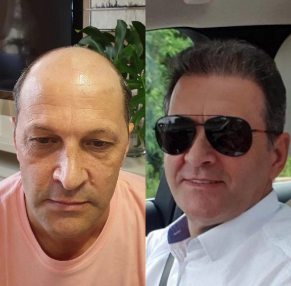 DHI Hair Transplant – The Future of Natural Hair Restoration