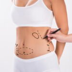 Best Liposuction Surgeons in Dubai Achieve Flawless Results