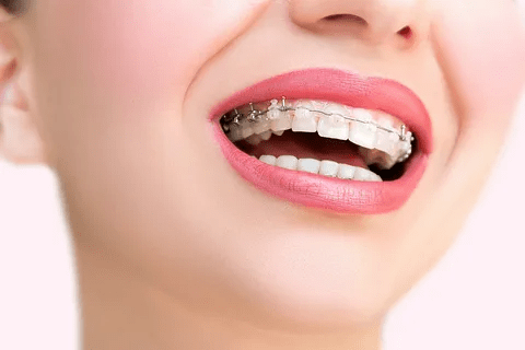 Dental Braces in Islamabad – Straighten Your Smile with Confidence