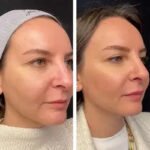 Best Plastic Surgeon in Dubai for Mesotherapy: Men’s Skin Rejuvenation