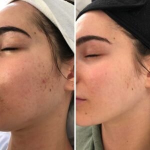 Microneedling with PRP in Islamabad