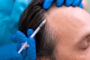 The Ultimate Guide to PRP Hair Treatment in Islamabad