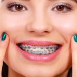 Are Braces the Right Choice for Your Smile?
