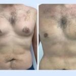 Gynecomastia in Dubai The Ultimate Solution for Male Gyno