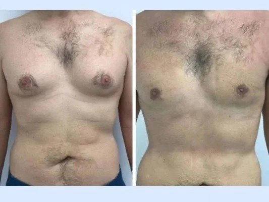 Gynecomastia in Dubai The Ultimate Solution for Male Gyno