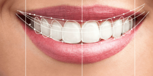 Hollywood Smile in Dubai by Expert Cosmetic Dentists
