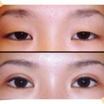 Puffy Eye Bag Removal in Islamabad – Smooth & Brighten Your Eyes