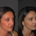 دور تقنية البيزو في تحسين نتائج تجميل الأنف قبل وبعد