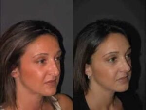 دور تقنية البيزو في تحسين نتائج تجميل الأنف قبل وبعد