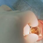 Precision Ear Reconstruction