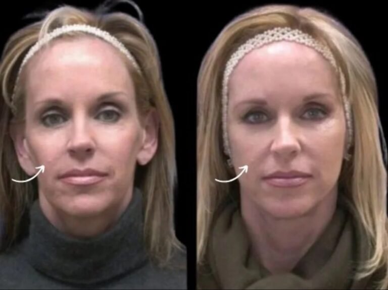 Best Doctors in Dubai for Viral Sculptra Transformations