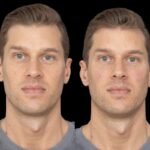 Best Doctors in Dubai Guide to Recovery After Under Eye Fillers