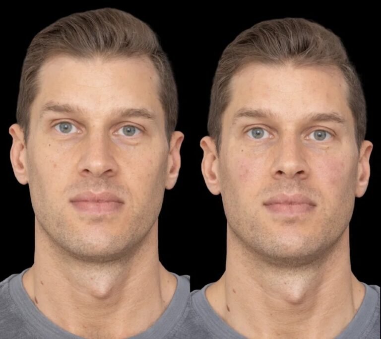 Best Doctors in Dubai Guide to Recovery After Under Eye Fillers