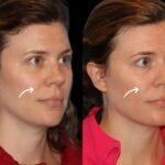 Sculptra Fillers Treatment in Dubai: Heat Resilient Aftercare