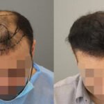 Transform Your Look with Hair Transplant in Abu Dhabi